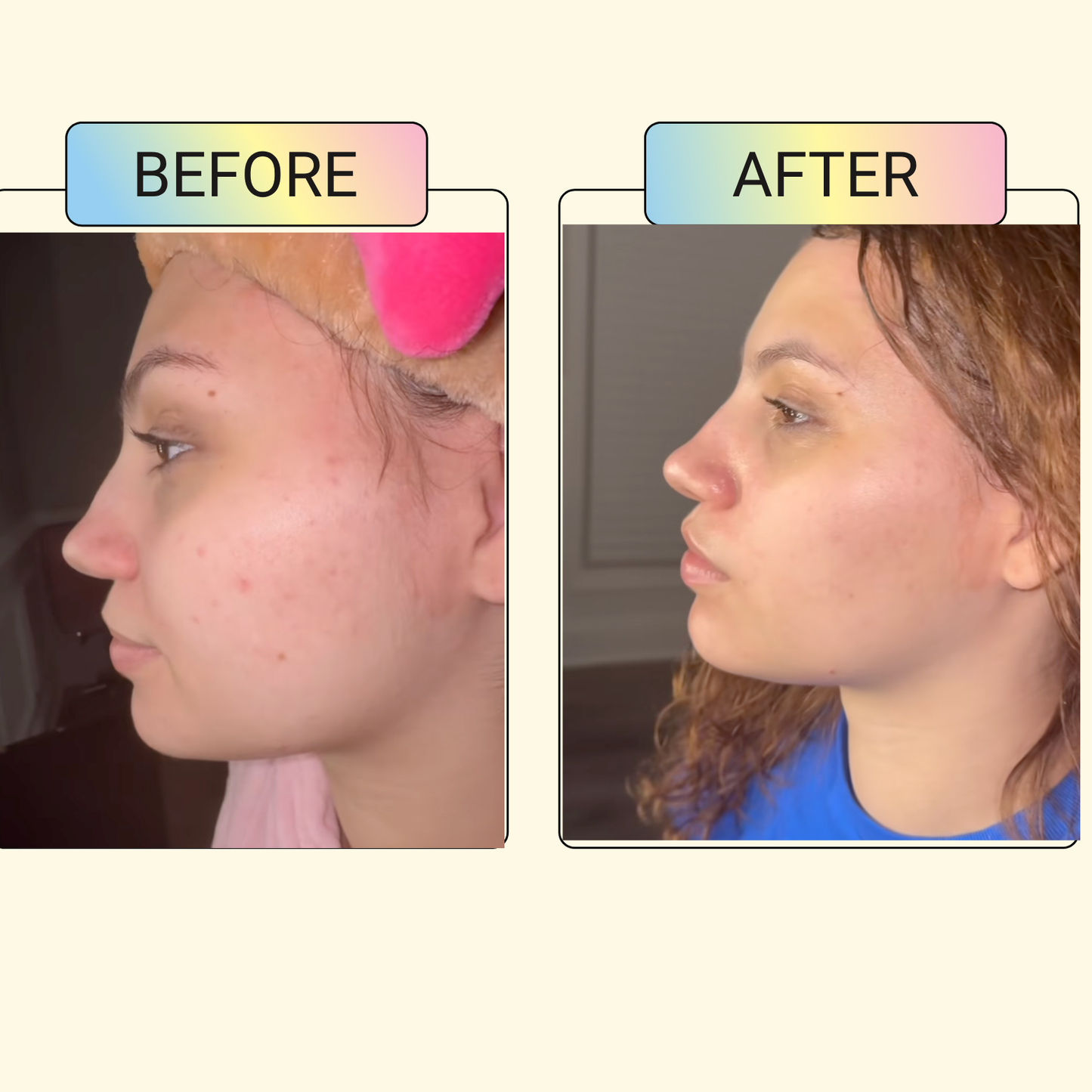 Spot Vanish Acne Drying Lotion.